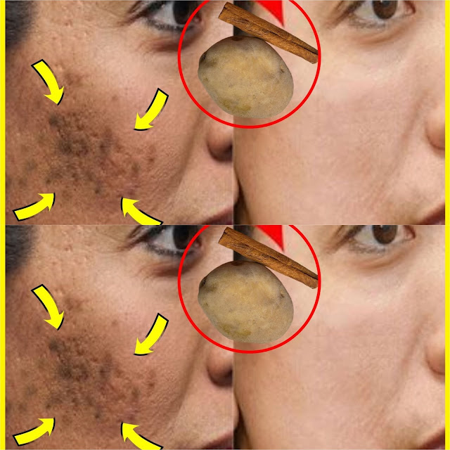 Naturalny blask: usuwanie plam słonecznych za pomocą ziemniaków i cynamonu