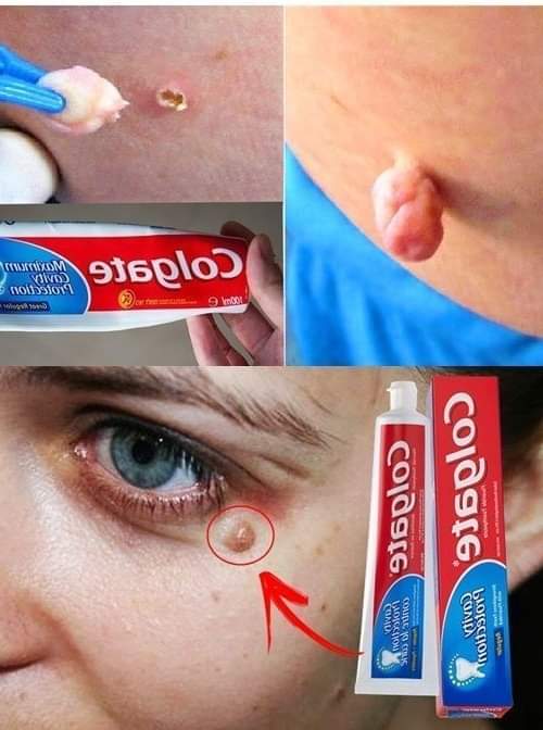 Usuń ciemne plamy, ciemne zacieki i naturalne przebarwienia