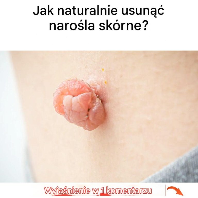 Jak naturalnie usunąć narośla skórne?