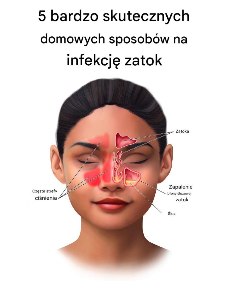 5 bardzo skutecznych domowych sposobów na infekcję zatok
