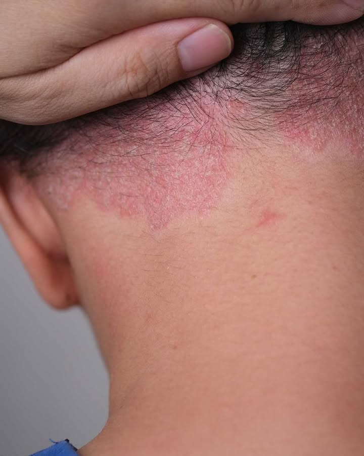 Odkryłem tę czerwoną plamę u mojego wnuka i wszyscy panikują. Co to jest i co powinniśmy zrobić?