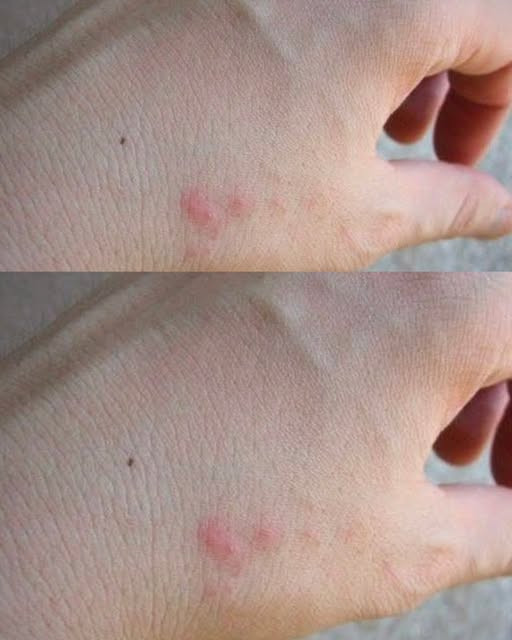 Pluskwy: 10 naturalnych sposobów na możliwe ukąszenia