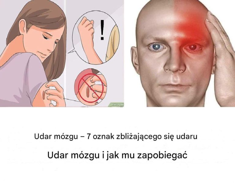 10 Ostrzegawczych Sygnałów przed Udarami: Na Co Zwrócić Uwagę, Zanim Będzie Za Późno