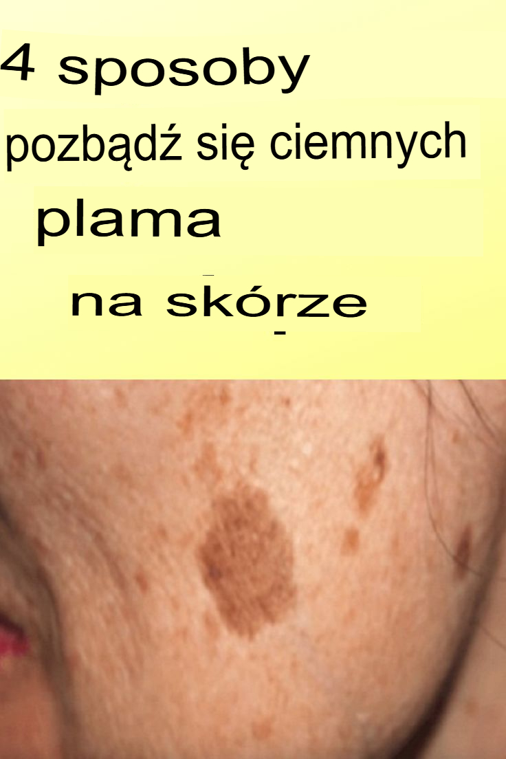 4 sposoby na pozbycie się ciemnych plam na skórze