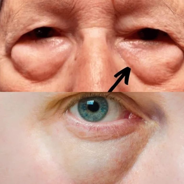 Szokująca prawda o workach pod oczami i cieniach pod oczami: Najniebezpieczniejsze przyczyny (Czy wiesz, że)