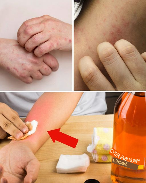 Te 4 problemy skórne można złagodzić, stosując ocet