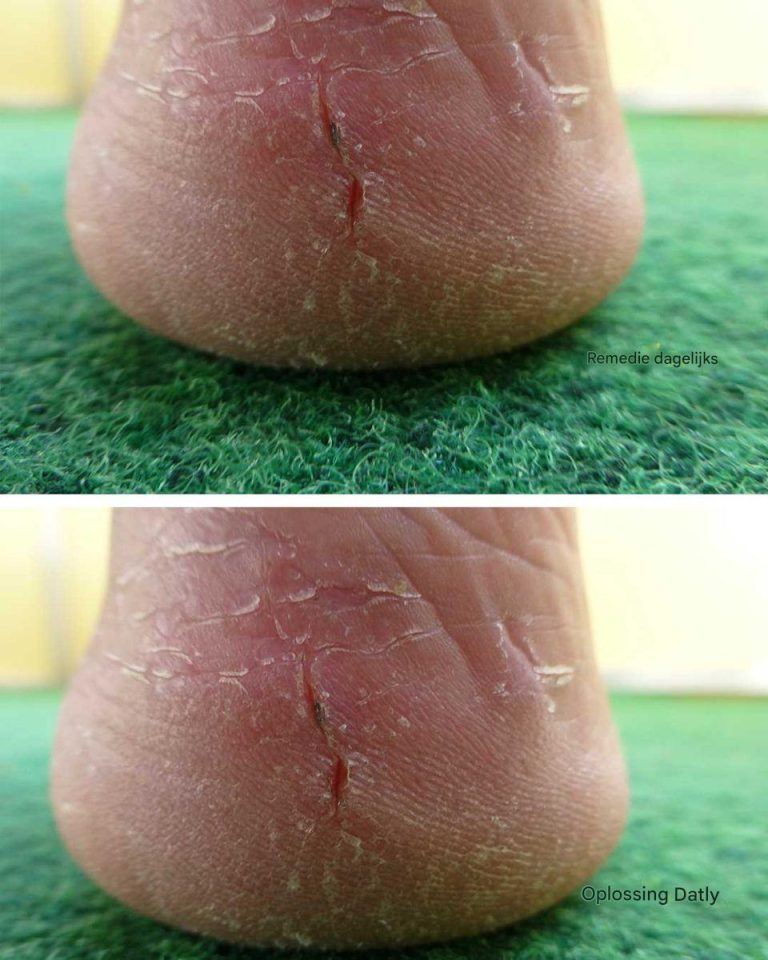 Moje pięty pękają – żaden balsam nie pomaga. Co jeszcze mogę zrobić? Czy powinnam pójść do lekarza?