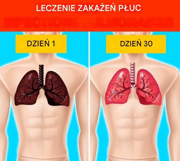 10 naturalnych sposobów leczenia infekcji płuc (domowe sposoby)