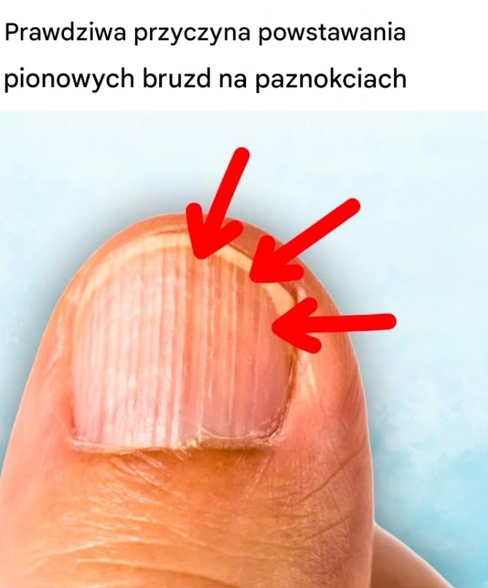 Pofałdowane, rozdwojone, miękkie: co Twoje paznokcie mówią o Twoim zdrowiu