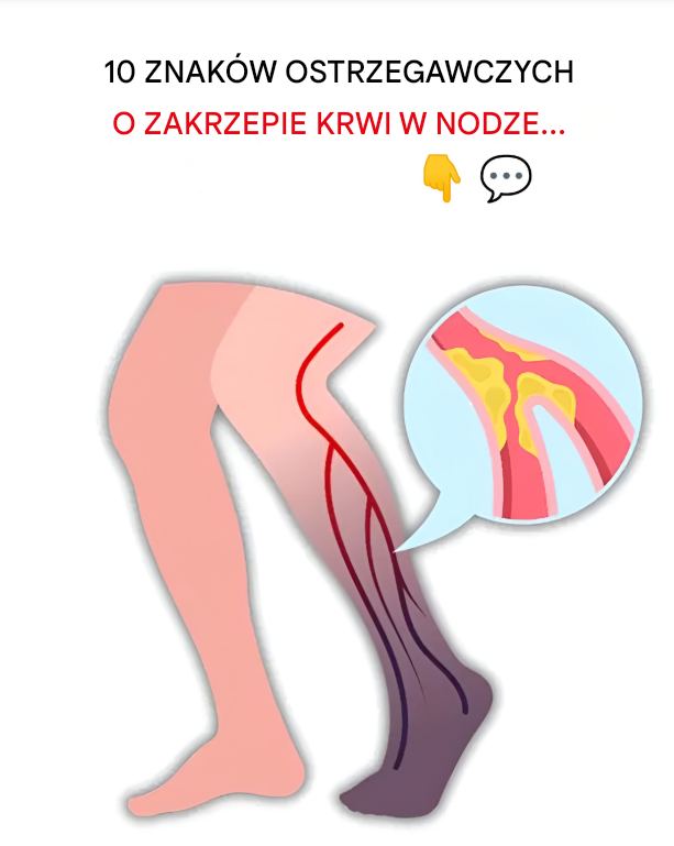 10 najważniejszych oznak zakrzepu krwi w nodze (zapobieganie zakrzepicy żył głębokich)
