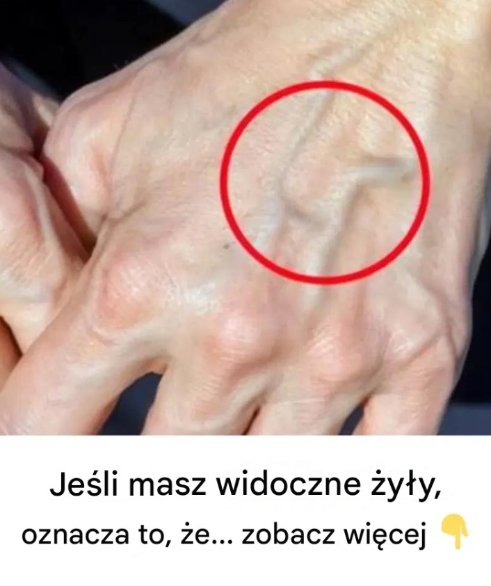 Kiedy należy martwić się żyłami, które pojawiają się znikąd