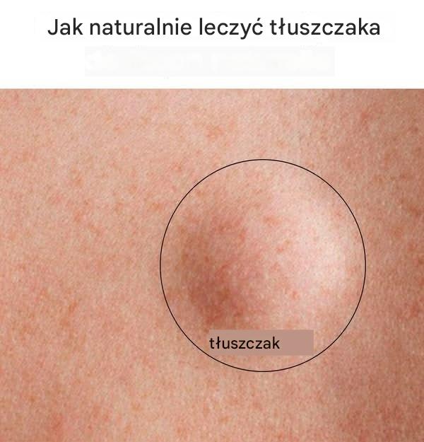 Jak leczyć tłuszczaka naturalnie