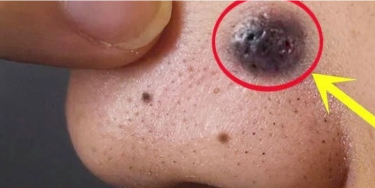 Usuń znamiona, brodawki, zaskórniki, narośla skórne i plamy starcze w sposób naturalny i trwały