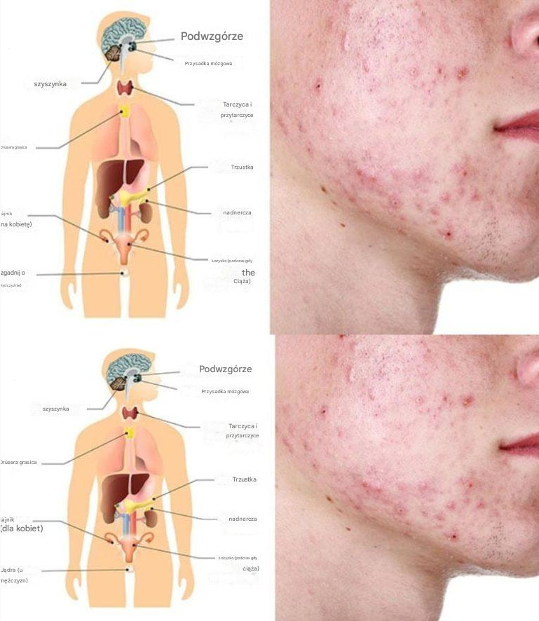5 produktów spożywczych, które niszczą hormony i skórę