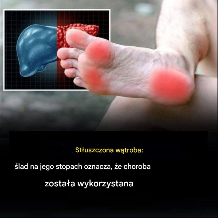 Stłuszczenie wątroby: znak na stopach, który oznacza początek choroby