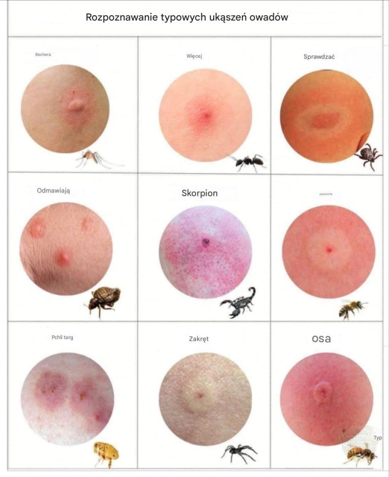 Ukąszenia owadów wyglądają inaczej. Rozpoznanie ich może prowadzić do szybszego leczenia i większego bezpieczeństwa.