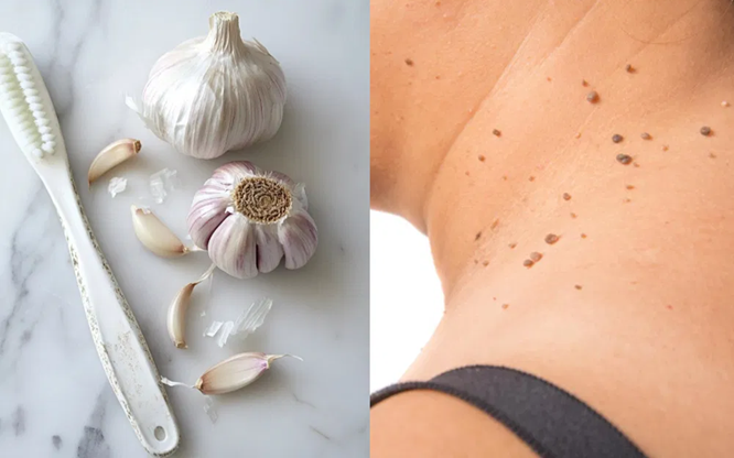 Brodawki podeszwowe i narośla skórne znikają naturalnie — wypróbuj ten środek na noc