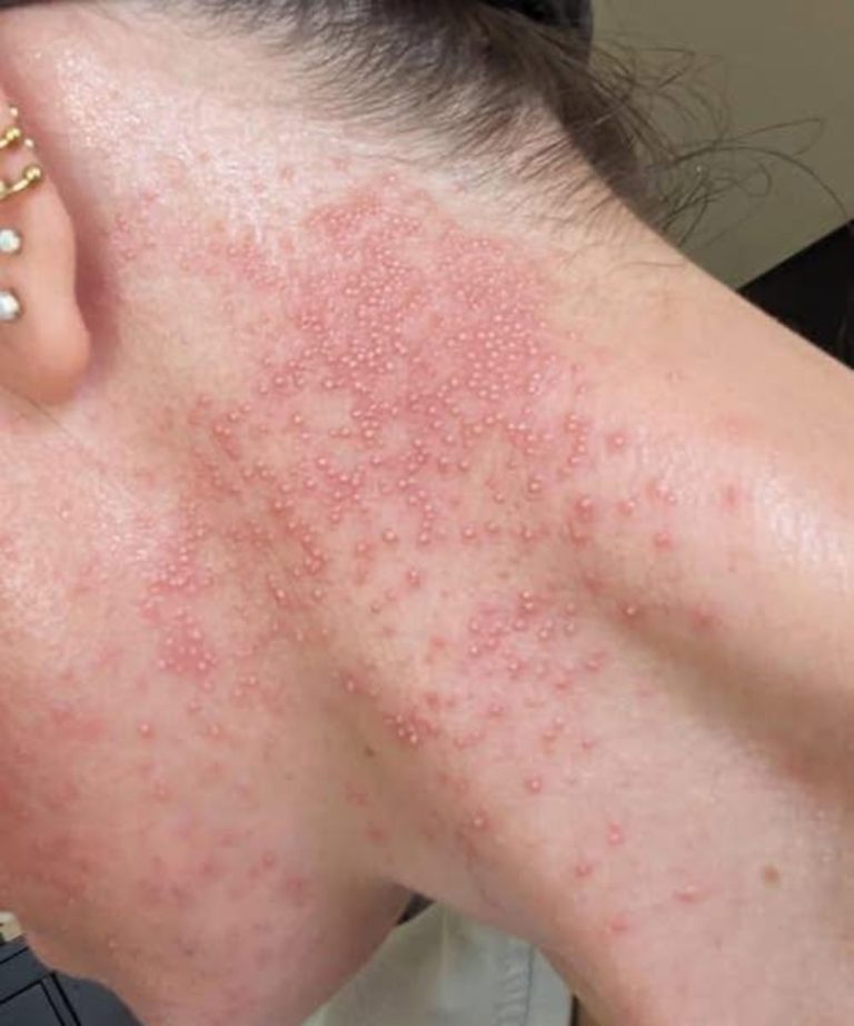 Oto konsekwencje jedzenia…