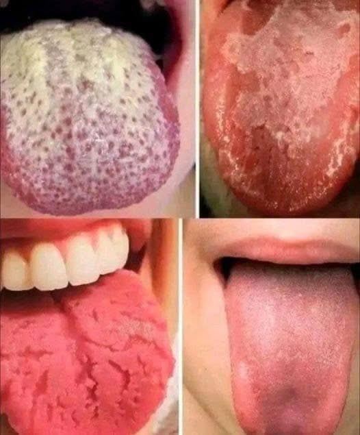 Jeśli odczuwasz te cztery objawy ze strony języka, mogą one wskazywać na choroby podstawowe.