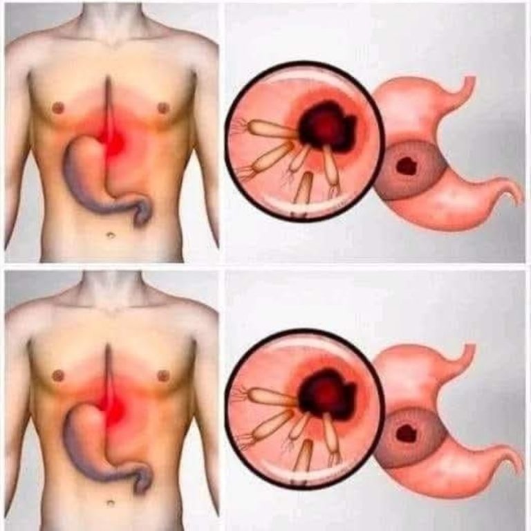 Oto jak wyeliminować bakterie powodujące zgagę i wzdęcia
