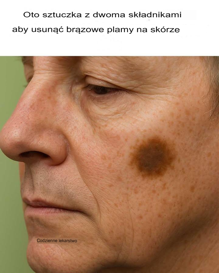 Oto dwuskładnikowy trik, który pozwoli Ci pozbyć się brązowych plam na skórze