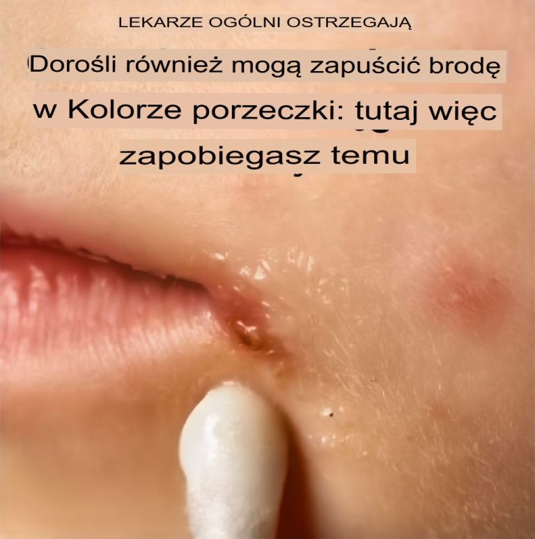 😨 Lekarze wyjaśniają:⚠️ Liszajec nie jest zarezerwowany tylko dla dzieci – oto jak chronić się jako osoba dorosła!