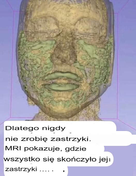 Rezonans magnetyczny twarzy 33-letniej kobiety pokazuje, gdzie zniknęły wszystkie wypełniacze