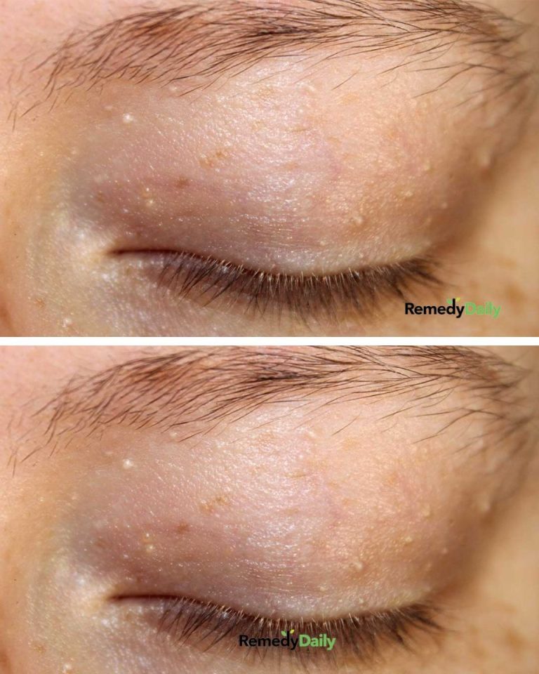 Mam wszystkie te białe grudki wokół oczu. Nie wyglądają jak pryszcze, więc nie jestem pewna, czy powinnam je wycisnąć. Co mogę zrobić?