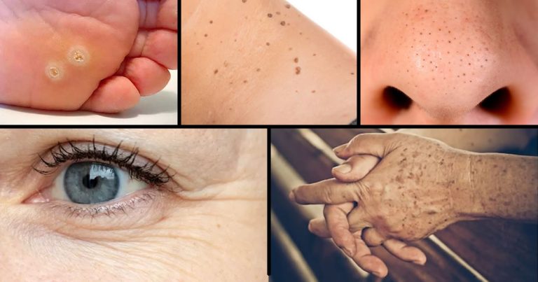 Jak naturalnie usunąć brodawki, zaskórniki, plamy i zmarszczki