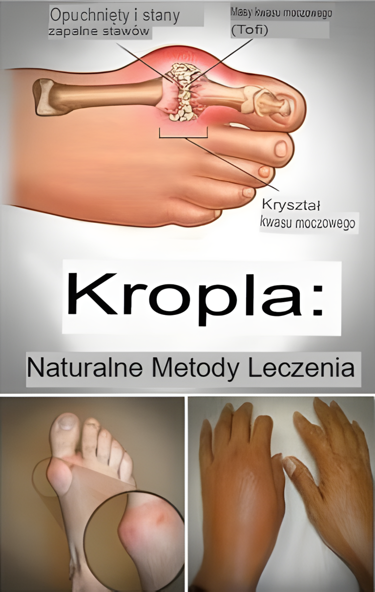 Pożegnaj się z dną moczanową na zawsze dzięki temu skutecznemu, naturalnemu sposobowi leczenia!