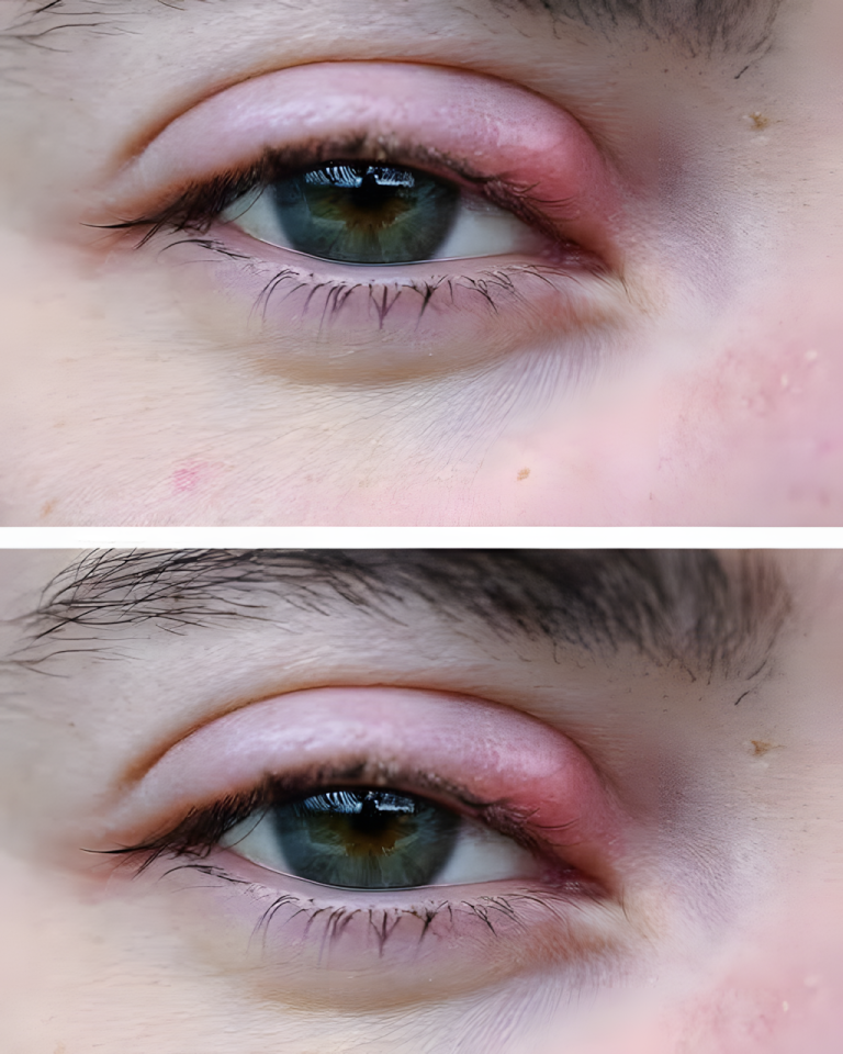 Pozbądź się orgelli w oku, wykonując następujące czynności