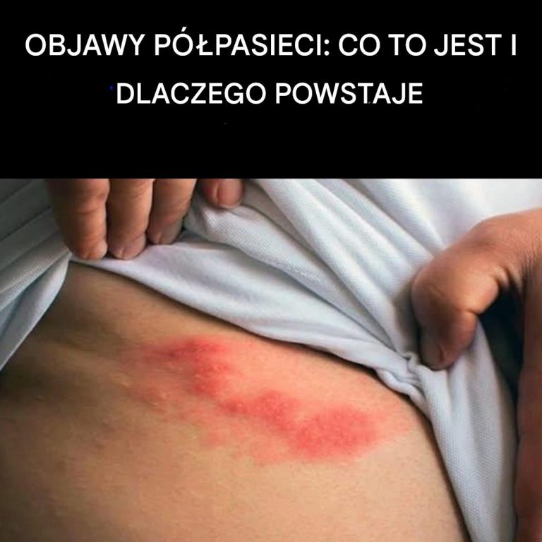 Czym jest półpasiec i jakie są jego objawy?