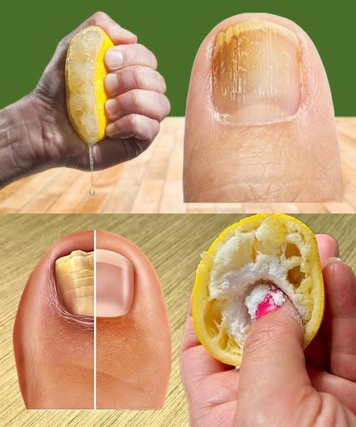 Pożegnaj się z uporczywą grzybicą paznokci u stóp dzięki temu naturalnemu lekarstwu