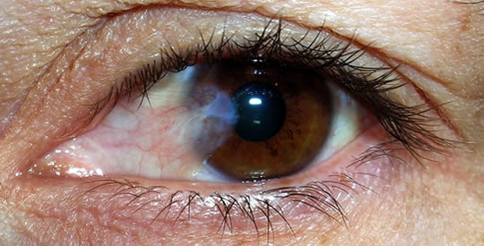 Co powoduje zaćmę i jak jej zapobiegać oraz leczyć ją naturalnie