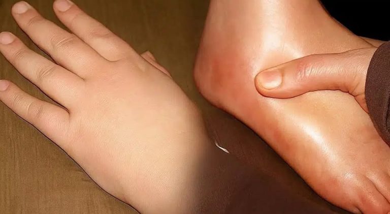 Jak szybko pozbyć się opuchniętych dłoni i stóp: domowe sposoby na zatrzymanie płynów