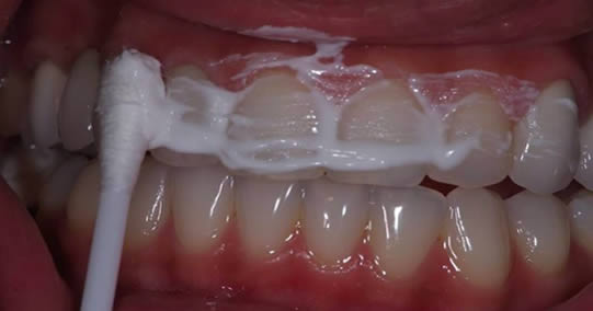 Naturalny środek usuwający kamień nazębny, leczący zapalenie dziąseł i wybielający zęby