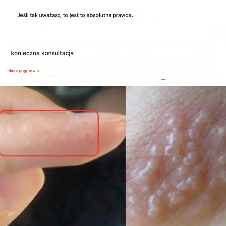 Jeśli zauważysz te czerwone, bolesne grudki, możesz cierpieć na tę chorobę.